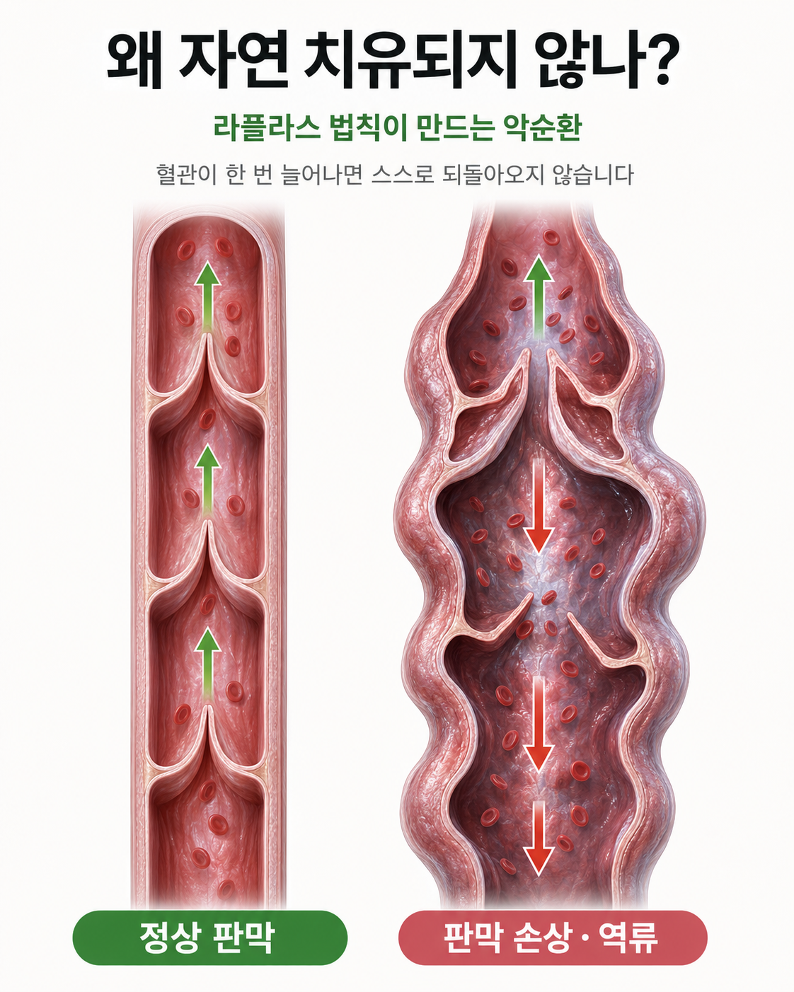 왜 자연 치유되지 않나 — 라플라스 법칙
