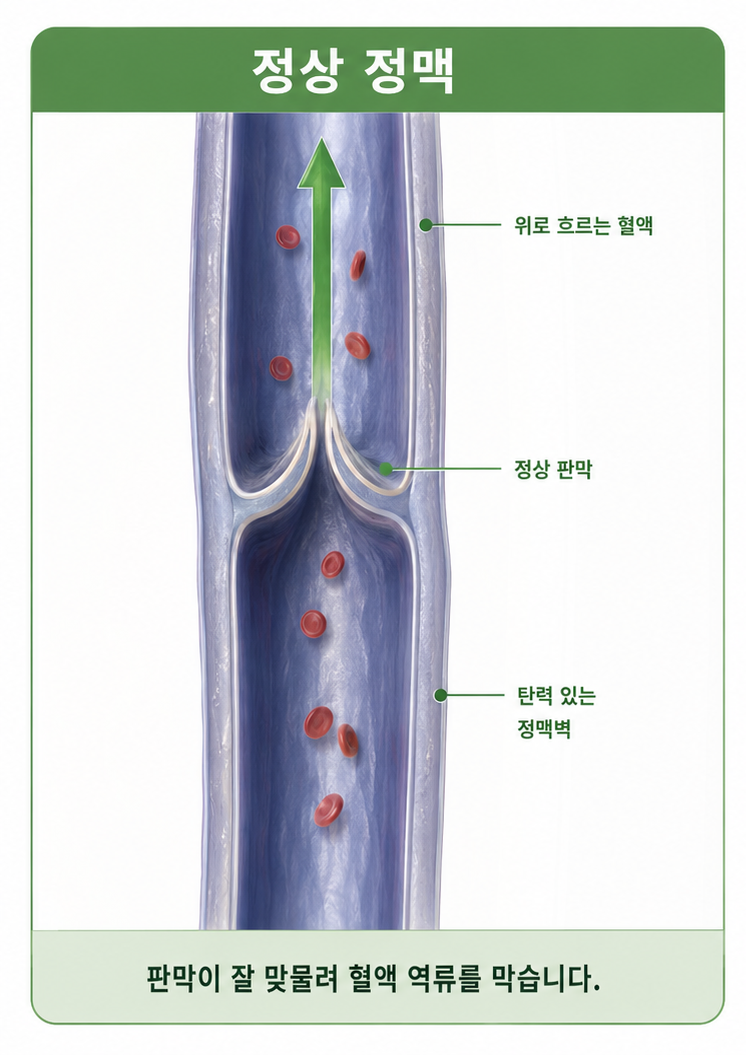 정상 판막