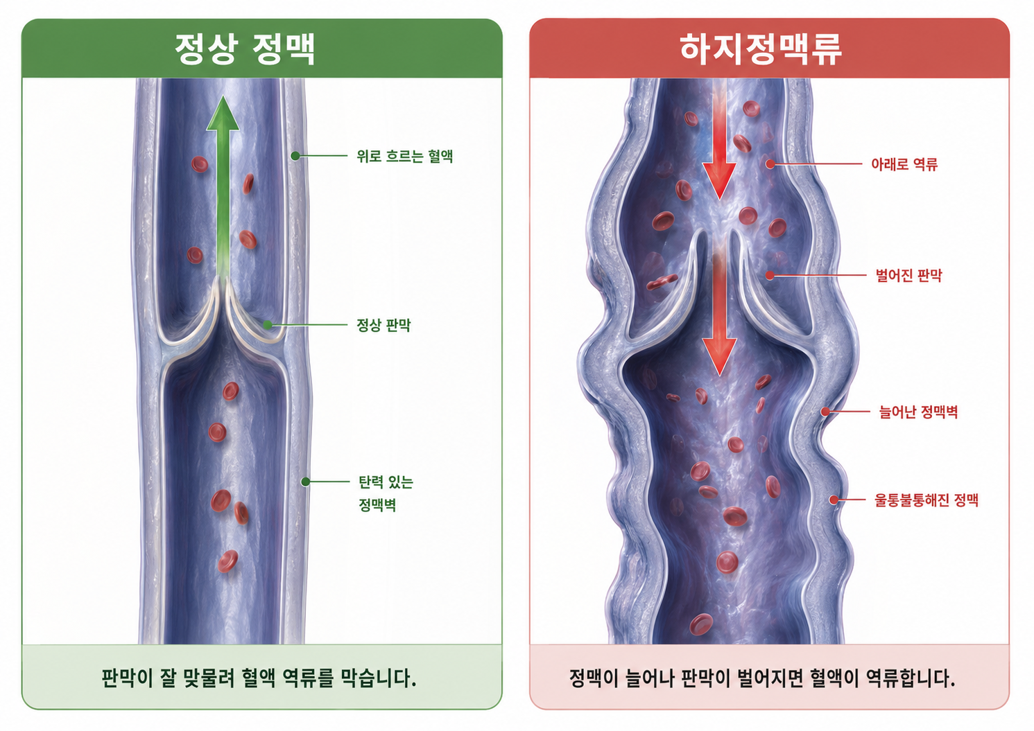 정상판막 vs 손상된 판막 비교 — 혈액 흐름 단면도