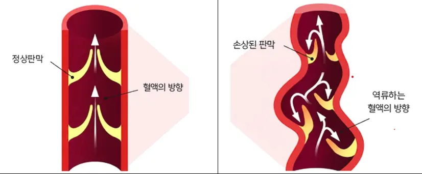 정상판막